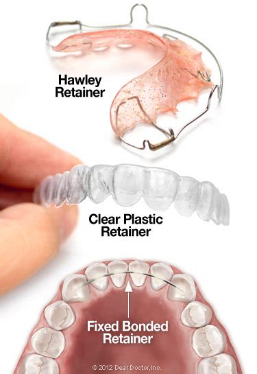 Retainers Keep That Perfect Smile Mack Orthodontics