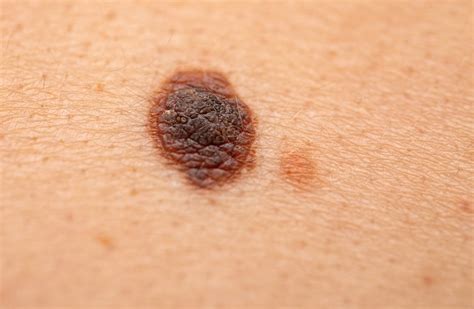 Melanocytic Naevus Ballarat Skin Cancer Centre