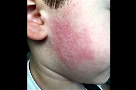 Derm Dx A Sudden Blotchy Rash On The Cheeks Clinical Advisor