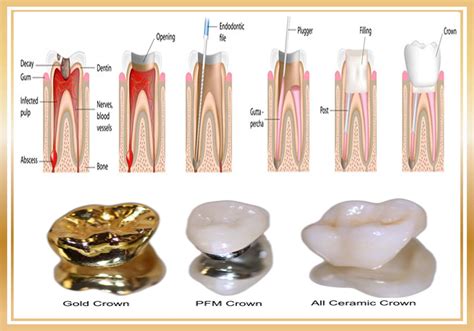 Root Canal Treatment