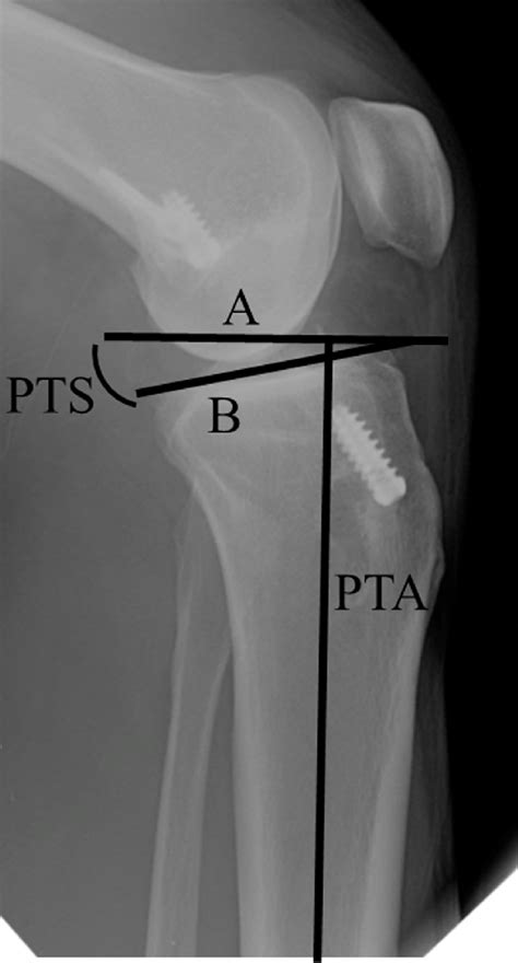 Posterior Tibial Slope Posterior Tibial Slope Was Calculated As The
