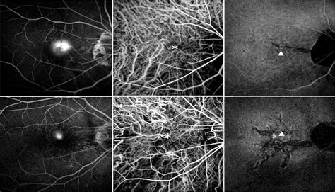Lacquer Crack Formation And Choroidal Neovascularization In Retina