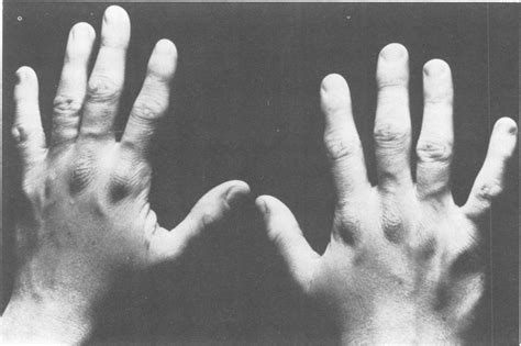 View Of Both Hands Of Patient Ii3 Showing Multiple Knuckle Pads And