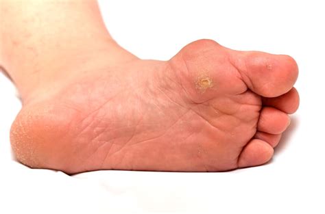 Corns Callus And Skin Problems Round House Podiatry
