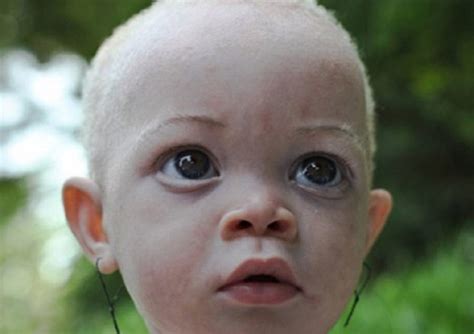 Albino People In Africa