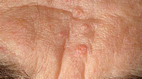 Sebaceous Hyperplasia Symptoms Causes And Treatment