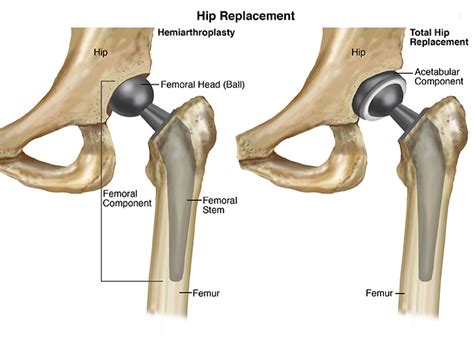 Choosing A Best Hip Replacement Implants Dr Santosh Shetty