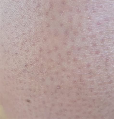 Keratosis Pilaris What Is It And Can It Be Treated Dr Nathan Holt
