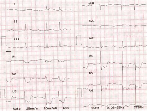 Ecg Anterior St Depression All About Cardiovascular System And