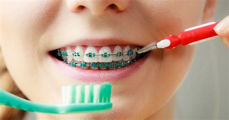 Advice From A Braces Dentist How To Take Care Of Braces