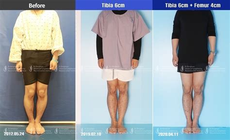 Increasing 10cm Of Height By Cosmetic Leg Lengthening Surgery Limb
