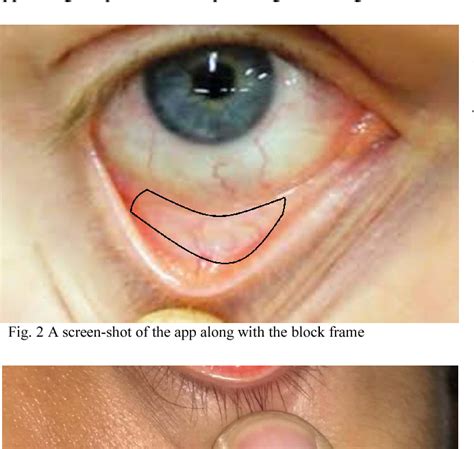 Detection Of Anemia From Image Of The Anterior Conjunctiva Of The Eye