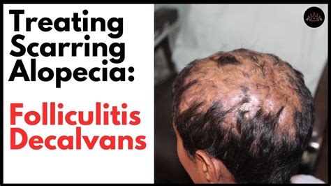 Folliculitis Hair Loss