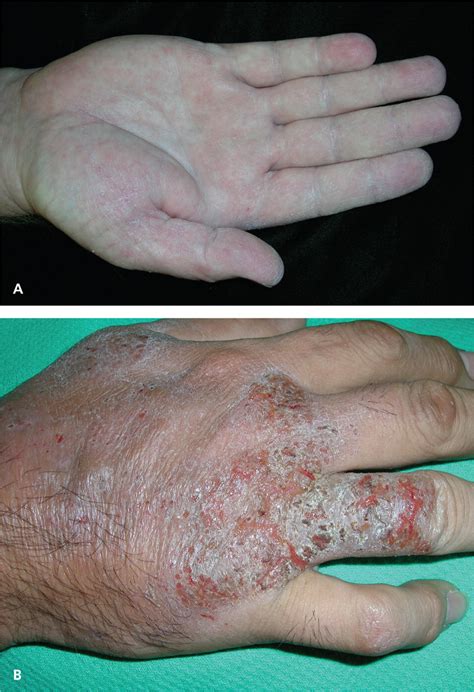 Irritant Contact Dermatitis Hand