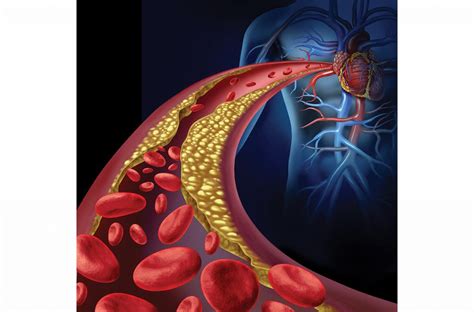 Enfermedad Arterial Coronaria No Obstructiva ¿cómo Diagnosticarla