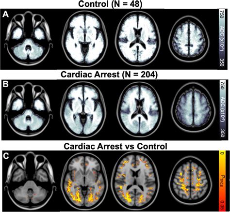 Regional Distribution Of Anoxic Brain Injury After Cardiac Arrest