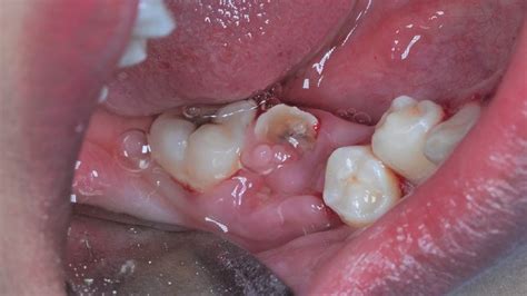 Broken Tooth Extraction Cabut Sisa Akar Gigi Bawah Dentist Dokter Gigi Tri Putra Youtube