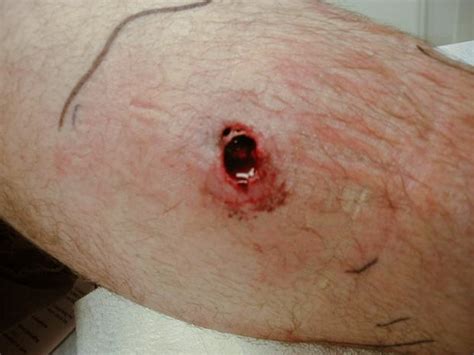 Brown Recluse Spider Bite Pictures Symptoms Stages