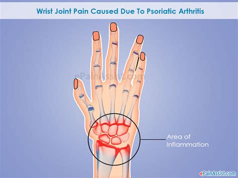 Wrist Pain 9 Major Medical Conditions That Cause Wrist Pain Or Wrist