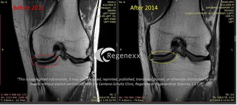 Can Stem Cells Help Knee Arthritis Regenexx®