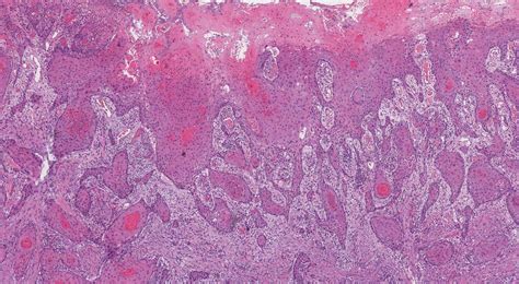 Carcinoma de células escamosas de cavidad oral MyPathologyReport ca