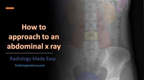 Abdominal Xray Introduction And Step By Step Approach In 10 Minutes