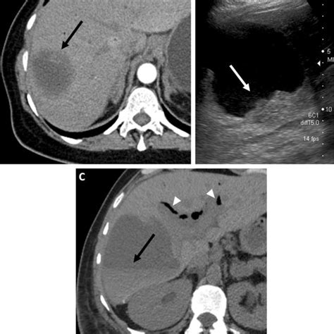 Hemorrhage Of A Renal Cyst A Baseline Axial T2 Weighted Mri In An