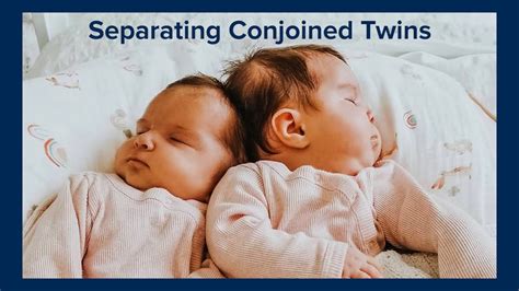 Opposite Sex Conjoined Twins Telegraph