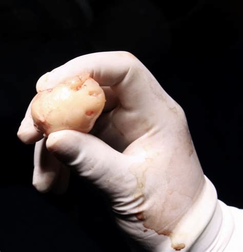 Issste Surgeons Remove Extremely Rare Giant Brain Tumor Bullfrag