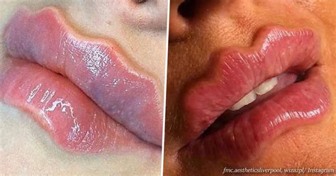 Wavy Lips The Latest Social Media Beauty Trend That Shocked Everyone