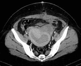 TAC abdominopélvico Utero miomatoso Imagen de masa anexial izquierda Download Scientific