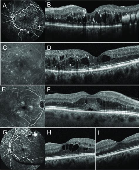 Multimodal Clinical Imaging Of Diabetic Macular Edema A B Optical