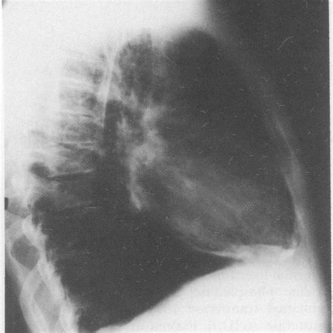 Lateral Chest Radiograph Showing Extensive Pericardial Calcification