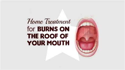 Home Treatment For Burns On The Roof Of Your Mouth1 Youtube