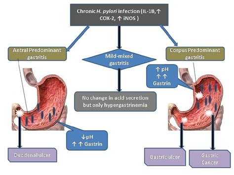 Shows Colonization Of H Pylori In Different Regions Of The Stomach