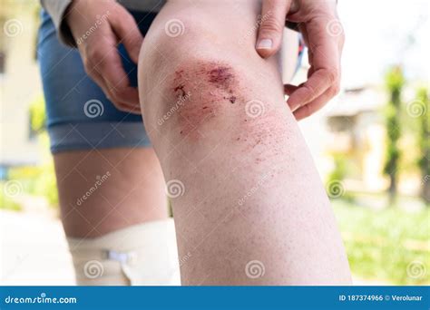 An Open Bleeding Wound On The Leg With Cleansed Skin Bruises And