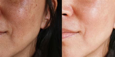 What You Should Know About Melasma Those Dark Spots On Your Face Self