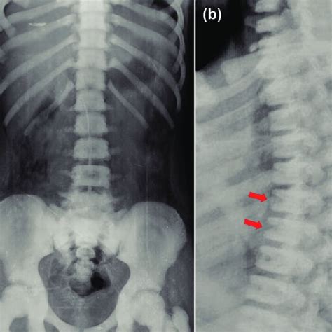 A Anteroposterior And B Transthoracic Lateral Shoulder Radiographs