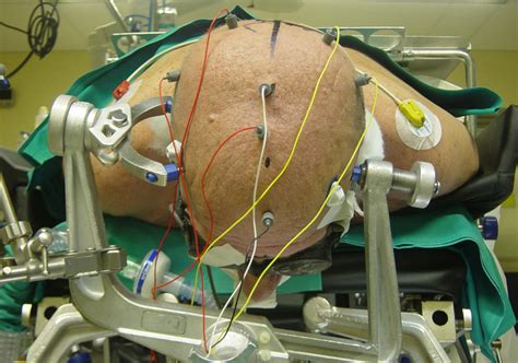 Overview Of Intraoperative Neurophysiological Monitoring Techniques