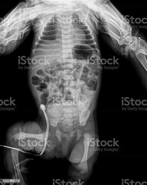 Xray Of Baby Stock Photo Download Image Now Neonatal Intensive Care