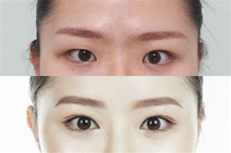 The Complete Guide To Korean Double Eyelid Surgery Eunogo