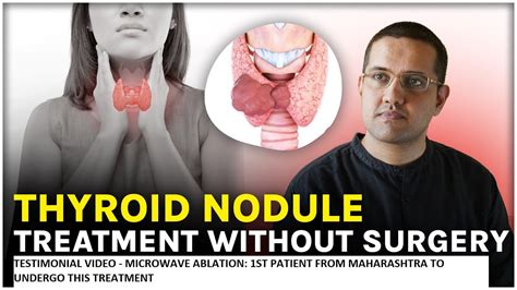 Testimonial Video Non Surgical Treatment Of Thyroid Nodule Ablation