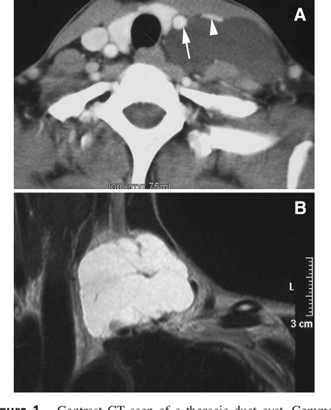 Figure 1 From Ok 432 Therapy For A Cervical Thoracic Duct Cyst