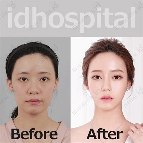Id Hospital 🌸 Define Your Identity 🌸 Plastic Surgery Face Surgery