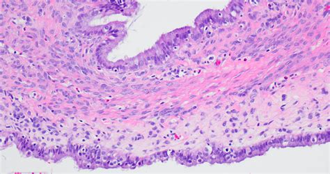 Pathology Outlines Seromucinous Cystadenoma And Adenofibroma