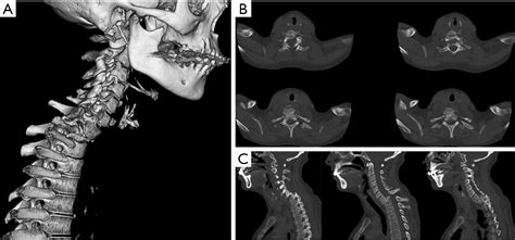 Treatment Of Chronic Traumatic C7t1 Grade Iii Spondylolisthesis With