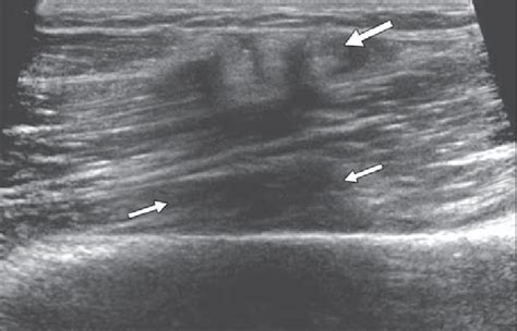 Year Old Man With Complete Distal Biceps Rupture Correctly Identified