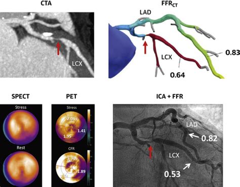 Comparison Of Coronary Computed Tomography Angiography Fractional Flow