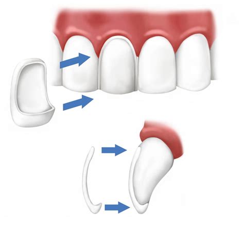 Veneers Seattle Smiles Dental