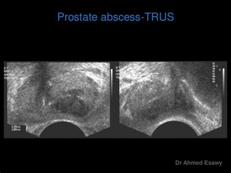 Imaging Prostatitis Urethritis Dr Ahmed Esawy